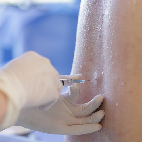 Epidural Steroid Injection