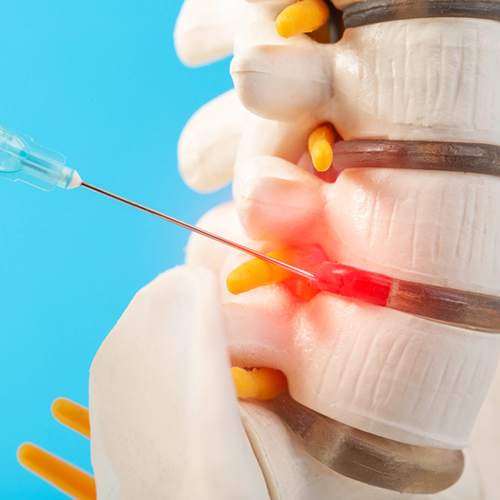 Facet Joint Injections